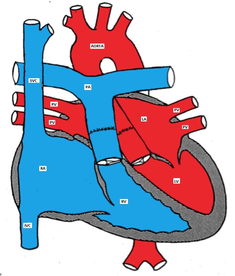 D-TGA after atrial switch surgery